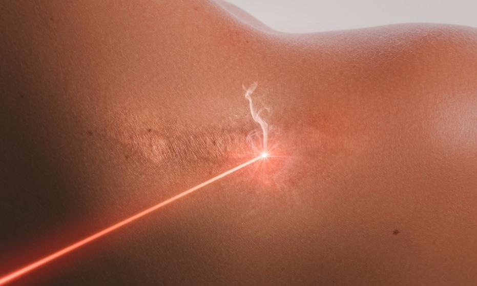 Laserowe usuwanie blizn. Co warto wiedzieć? Laserowe usuwanie blizn. Co warto wiedzieć?