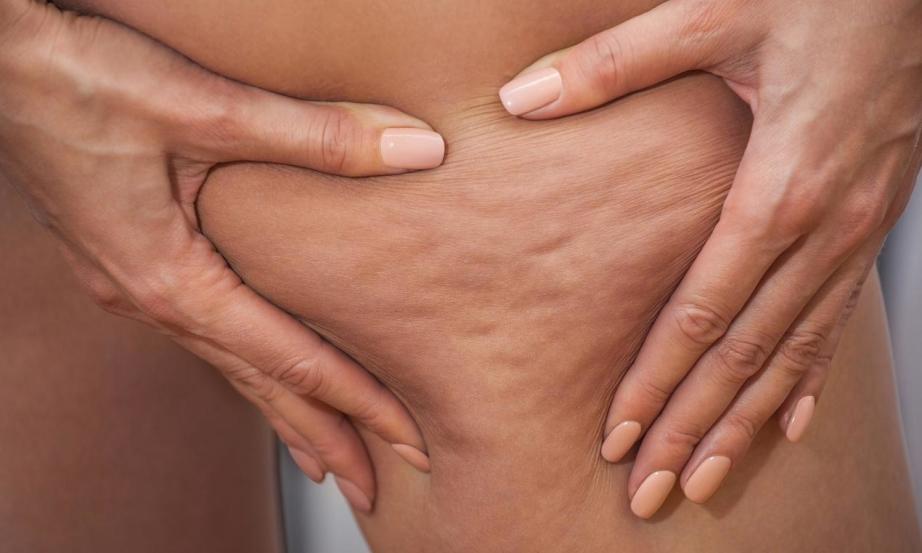 Jak zredukować cellulit?