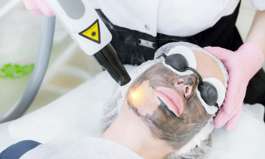 Na czym polega laserowy peeling węglowy? 