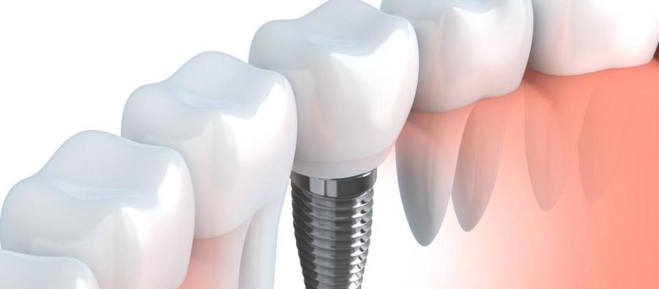 Rodzaje implantów zębowych Rodzaje implantów zębowych