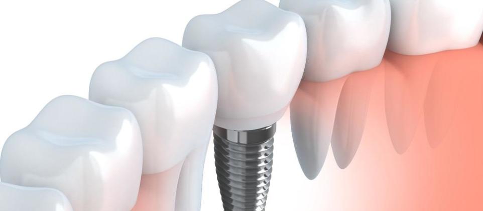 Rodzaje implantów zębowych