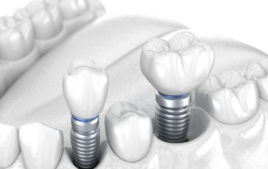 Jakie są zalety stosowania implantów zębowych w porównaniu do tradycyjnych protez?