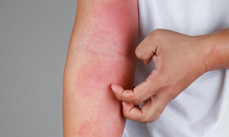 Metody leczenia atopowego zapalenia skóry