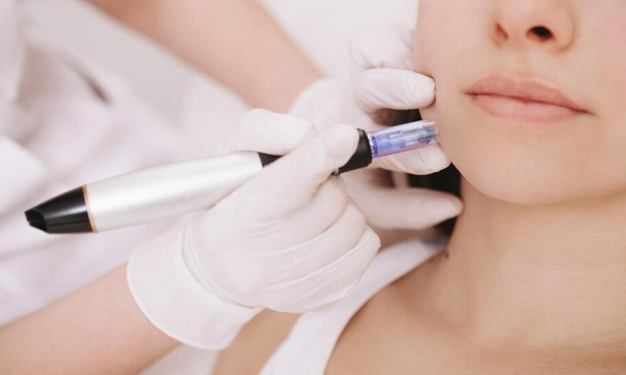 Efekty zabiegu microneedlingu – co można osiągnąć?