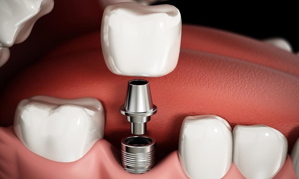 Wszczepianie implantów zębowych. Przebieg zabiegu Wszczepianie implantów zębowych. Przebieg zabiegu