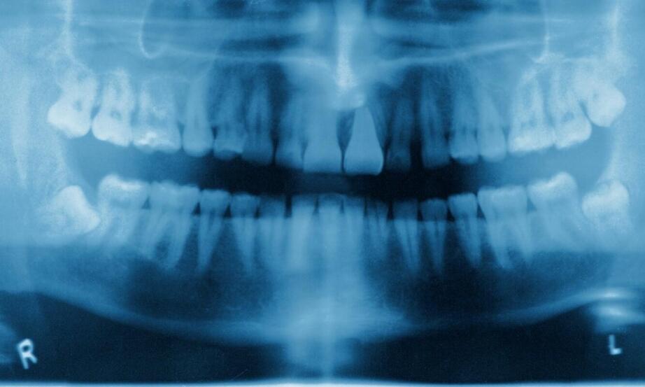 Jakie są etapy wykonania rtg zębów w gabinecie stomatologicznym?