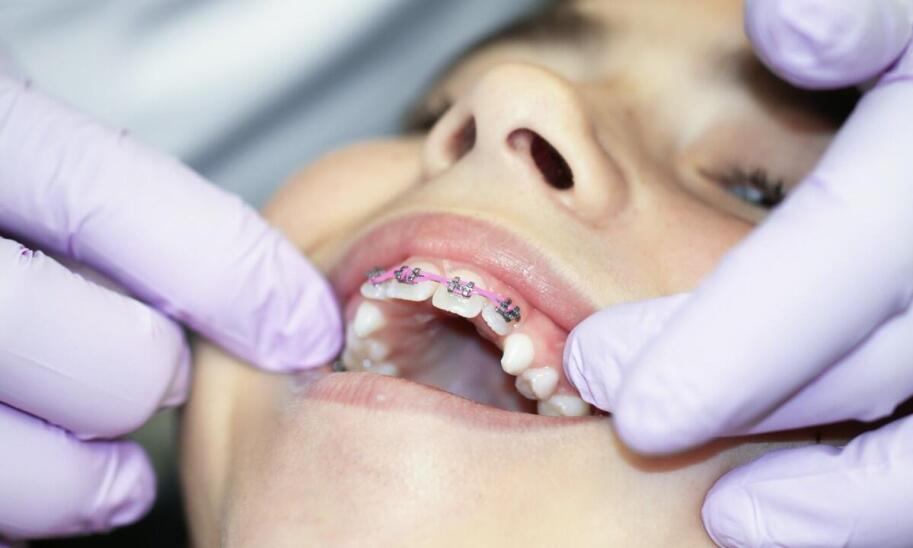 Jakie są wyzwania związane z noszeniem aparatu stałego przez dzieci?