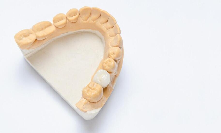 Różne rodzaje koron zębowych – które wybrać?