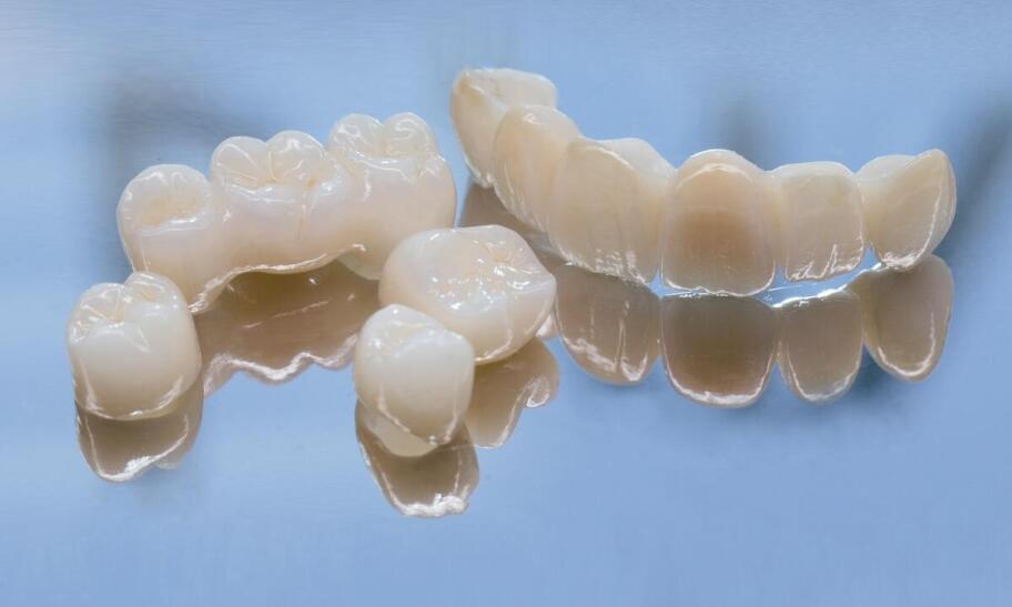 Czy mosty na włóknach mogą zastąpić zębowe implanty?