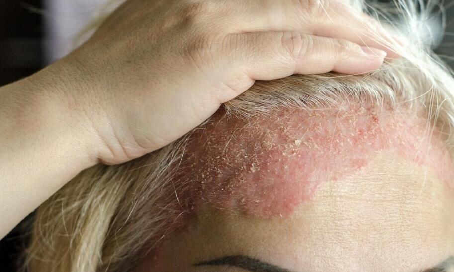 Czy ospę wietrzną trzeba smarować?