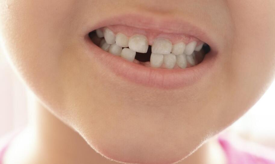 Które zęby mleczne wypadają jako pierwsze u dzieci