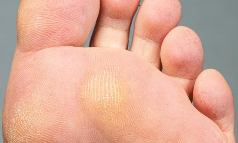 Odcisk czy modzel? Jak rozpoznać problem i dobrać odpowiednie leczenie?