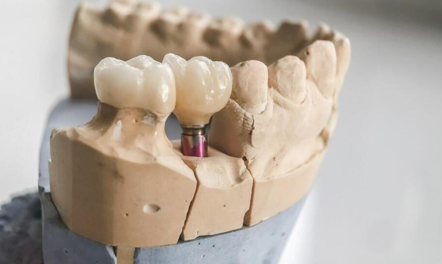 Ile implantów potrzeba na górną szczękę?