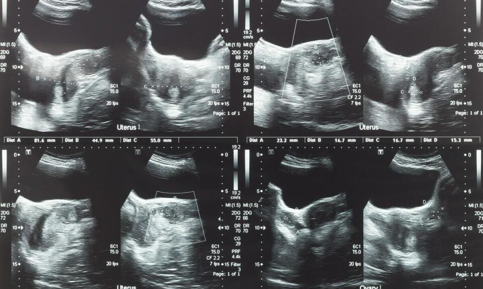Endometrioza ukryta za niepłodnością — kiedy obserwacja cyklu wymaga szerszej diagnostyki