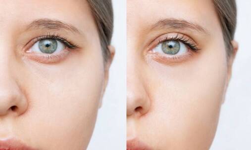 Dla kogo jest przeznaczona korekta powiek i czy warto dokonać tego zabiegu?