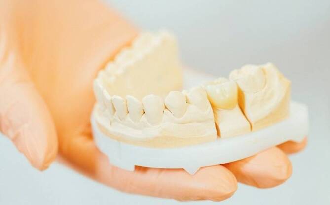 Korony i mosty protetyczne: rozwiązania dla osób z brakami w uzębieniu