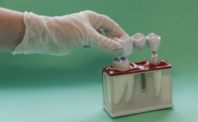 Czym wyróżniają się implanty All-on-6 i kiedy warto je wybrać?