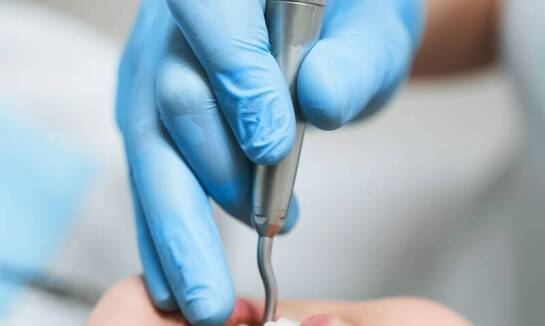 Scaling - kluczowy krok w utrzymaniu zdrowych dziąseł i zębów