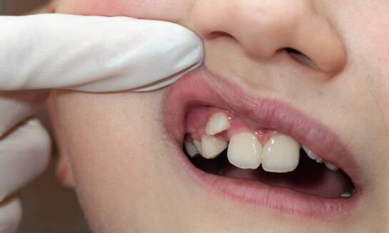 Ruszające się zęby po zdjęciu aparatu - czy jest się czego obawiać?