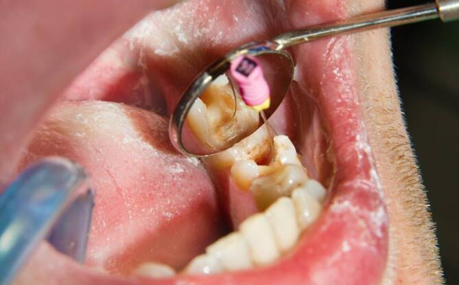 Przebarwienia - czy mogą sugerować poważne problemy z uzębieniem?