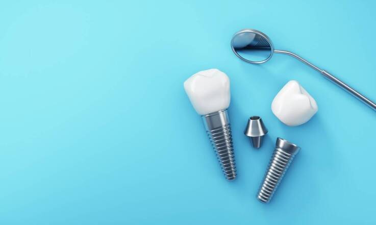 Proces zakupu implantów zębów: co warto wiedzieć przed podjęciem decyzji?