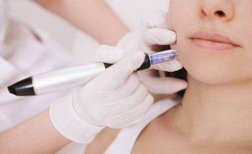 Efekty zabiegu microneedlingu – co można osiągnąć?