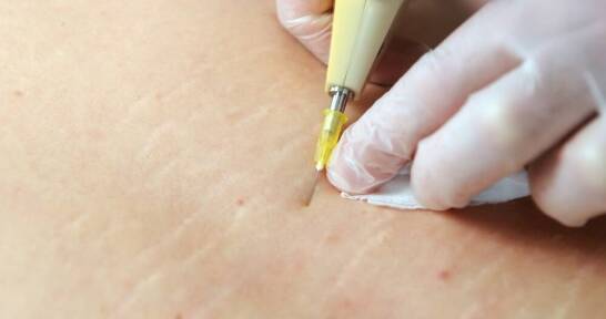 Hirudoterapia jako alternatywa dla farmakologii w walce z bólem