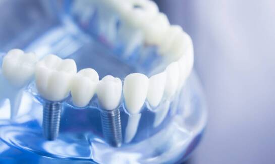 Zalety stosowania czynników wzrostowych przy zakładaniu protez na implantach