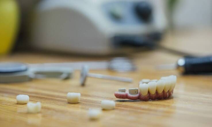 Jakie korzyści niesie ze sobą zastosowanie overdenture na implantach?