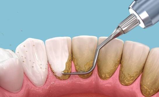 Na czym polega i jak przebiega skaling zębów?
