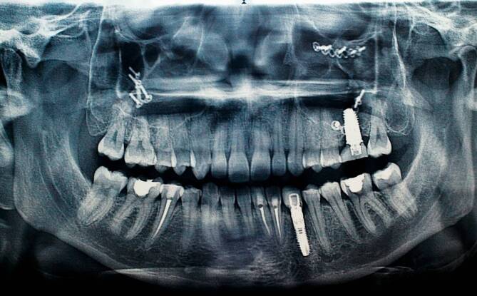 Nowoczesne metody obrazowania w planowaniu implantacji zębów
