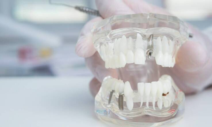 Jakie korzyści niesie ze sobą regeneracja kostna przed implantacją?
