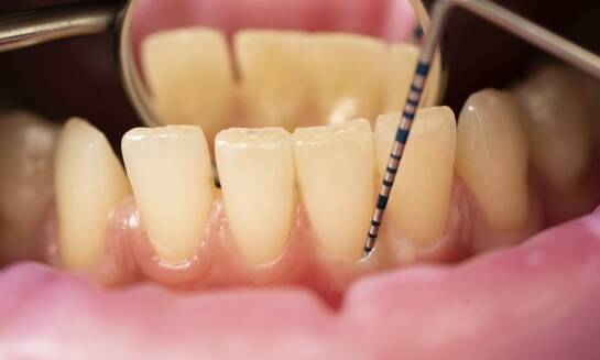 Proces gojenia po wszczepieniu implantu zębowego