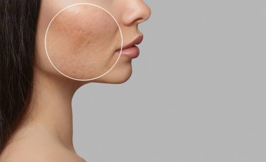 Blizny po trądziku – jakie zabiegi polecają eksperci medycyny estetycznej?