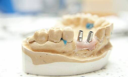 Od czego zależy trwałość implantów zębowych?