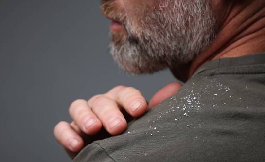 Łuszczyca czy grzybica głowy – jak je rozróżnić i kiedy iść do lekarza?