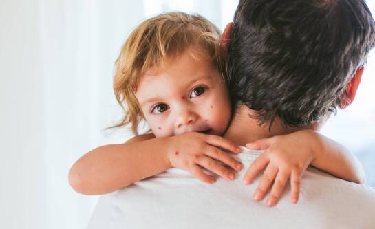 W czym kąpać dziecko z ospą, żeby złagodzić świąd i podrażnienia?