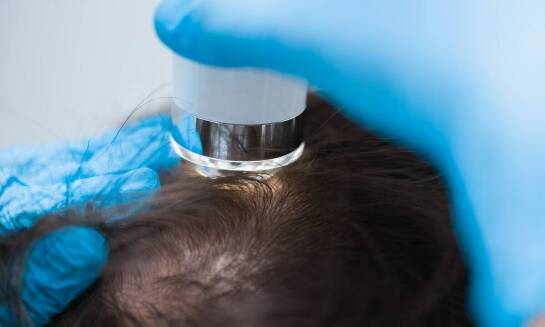 System włosów jako rozwiązanie dla osób z genetycznym brakiem owłosienia