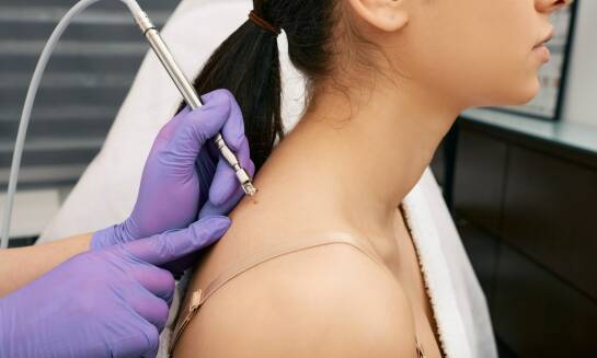 Rola kriochirurgii w leczeniu kłykcin kończystych