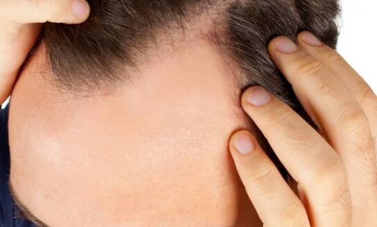 Przeszczepy włosów - metody i zastosowanie w San-Medical