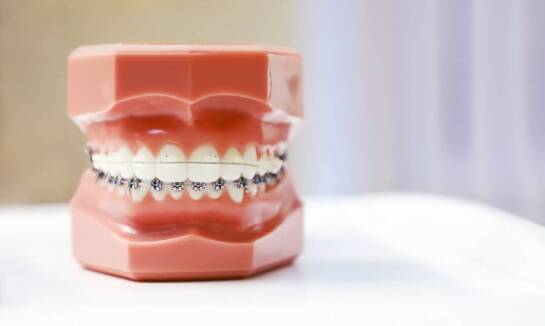 Nakładki invisalign – idealne dopasowanie dzięki technologii 3D
