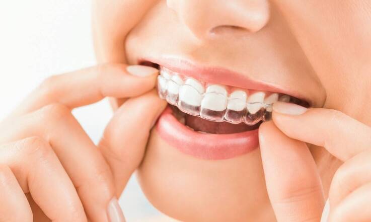 Dlaczego Invisalign jest mniej widoczny niż tradycyjne aparaty?