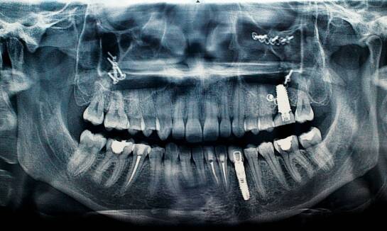 Na czym polega zdjęcie panoramiczne zębów i kiedy jest wykonywane?