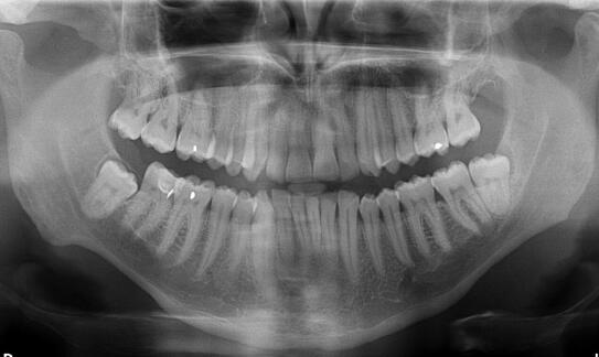 Jak zdjęcie pantomograficzne wpływa na diagnostykę ortodontyczną?