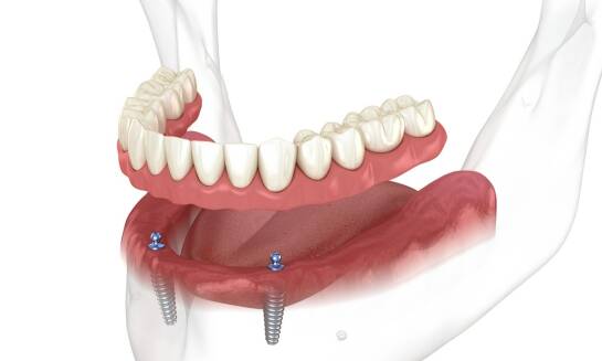 Przewaga implantów nad innymi metodami uzupełniania brakujących zębów