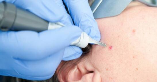 Jakie efekty można osiągnąć dzięki laserowi CO2 w medycynie estetycznej?