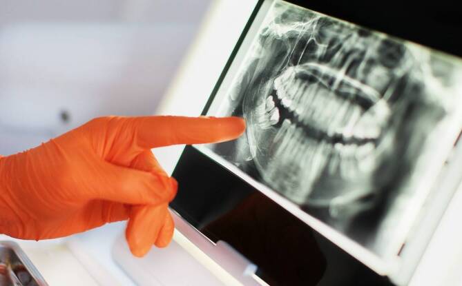 Rola zdjęć pantomograficznych i cefalometrycznych w kompleksowej diagnostyce stomatologicznej