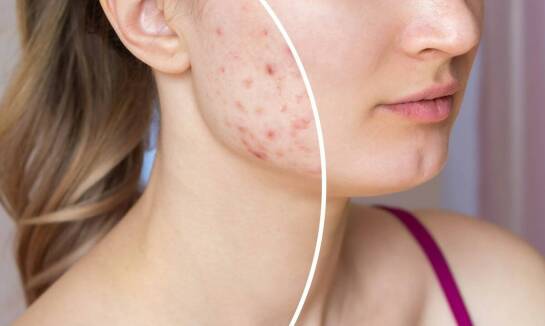 Jak trądzik wiosenny wpływa na cerę naczyniową i jak go kontrolować?