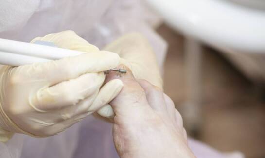 Dlaczego warto usunąć odcisk z korzeniem w gabinecie podologicznym?