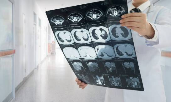 Prześwietlenie płuc jako narzędzie w ocenie skuteczności leczenia